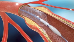 Pittsburgh angioplasty or stent procedure injury