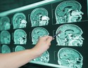 How Common Are Traumatic Brain Injuries After Car Accidents?