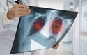 Liability for Failure to Diagnose Lung Cancer