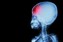 brain-injuries