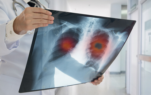 Liability for Failure to Diagnose Lung Cancer
